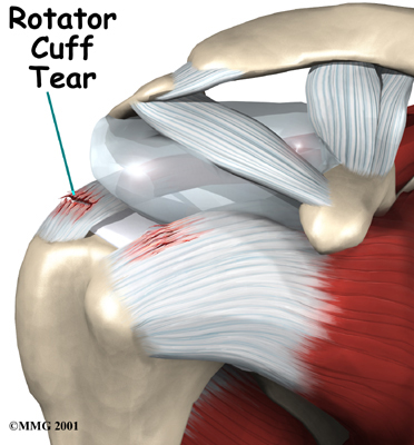 Physiotherapy in Toronto for Shoulder - Rotator Cuff Tears