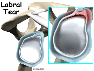Torn labrum shoulder deals