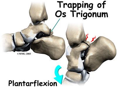 Синдромы голеностопного сустава. Импиджмент синдром голеностопного сустава. Os Trigonum таранной кости. Задний импинджмент голеностопного сустава. Импинджмент таранной кости.
