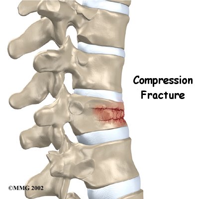 Physiotherapy in Toronto for Spinal Compression Fractures
