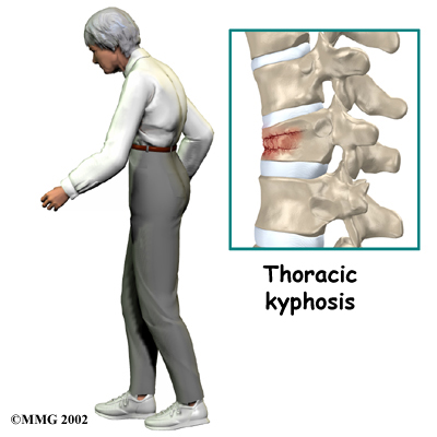 Compression fractures of the back Information