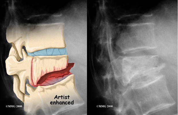 Guiding Your Patient Through Vertebral Compression Fracture