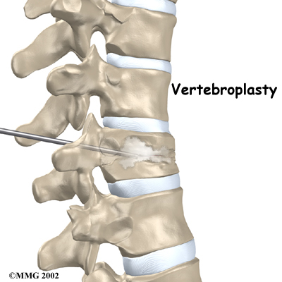 Physiotherapy in Toronto for Spinal Compression Fractures