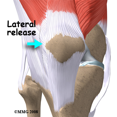 Misaligned patella shop