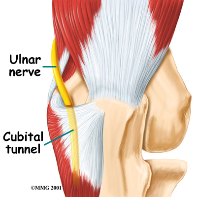 Physiotherapy in Toronto for Elbow - Cubital Tunnel Syndrome