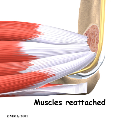 Physiotherapy in Toronto for Elbow - Cubital Tunnel Syndrome