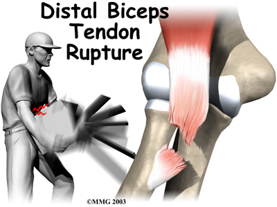 Proximal biceps clearance tendon rupture