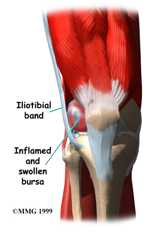 Physiotherapy in Toronto for Knee - Iliotibial Band Syndrome