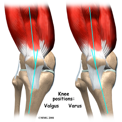 ILIOTIBIAL BAND CONTRACTURE - Innovative Therapy Canada